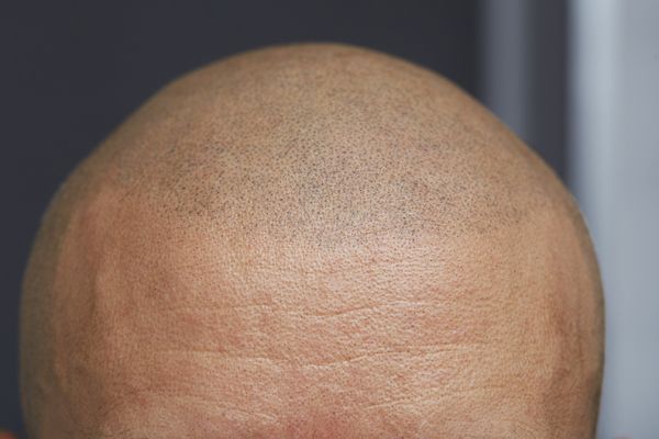 Tricopigmentación del cuero cabelludo
