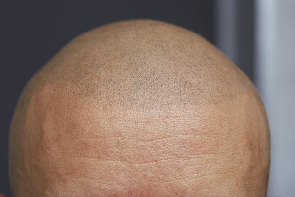 Scalp tricopigmentation